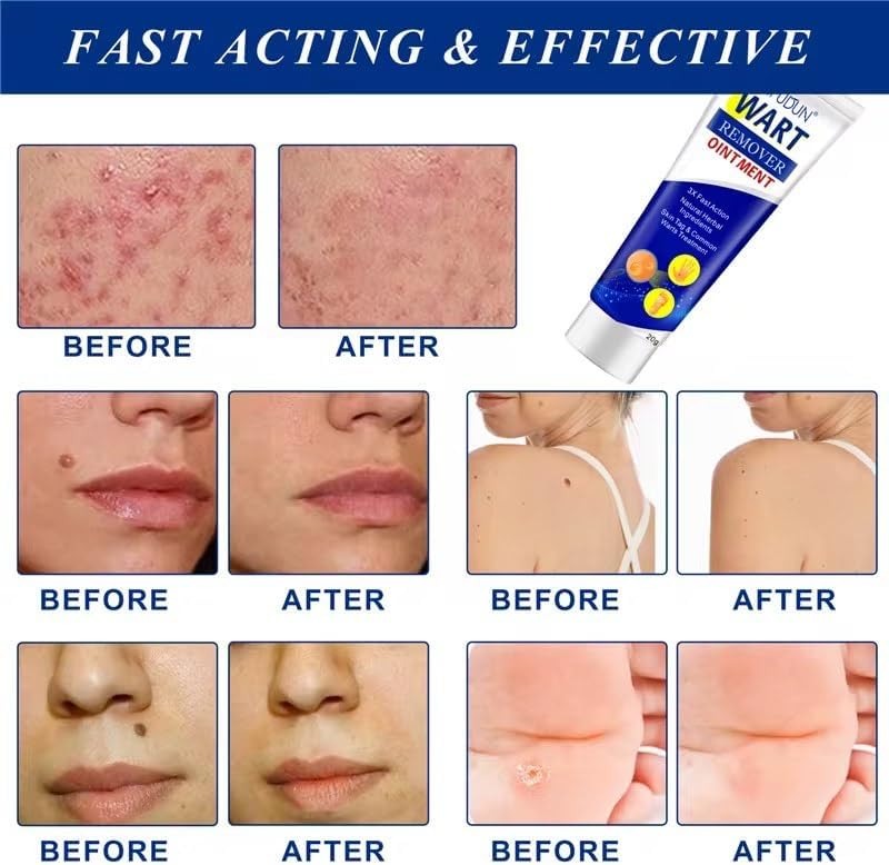 Wart Remover – Fast-Acting Wart Removal for Common & Plantar Warts
